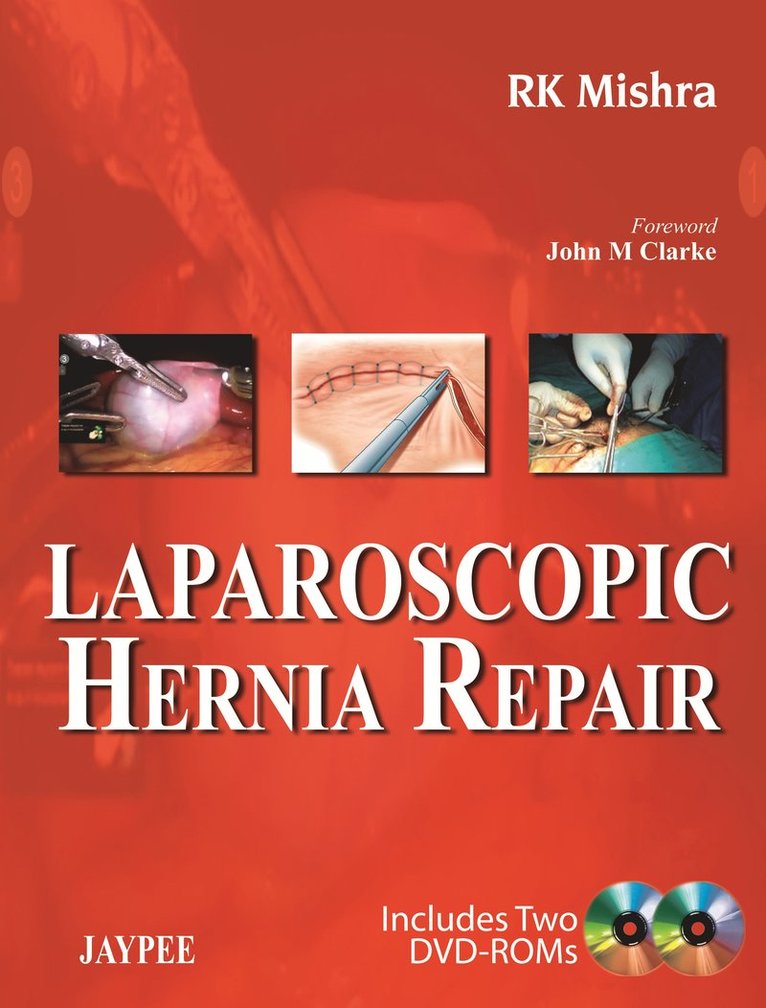 Laparoscopic Hernia Repair 1