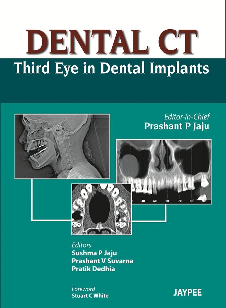 Prashant P Jaju - Dental CT Third Eye in Dental Implants, Inbunden
