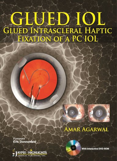 Amar Agarwal - GLUED IOL, Inbunden