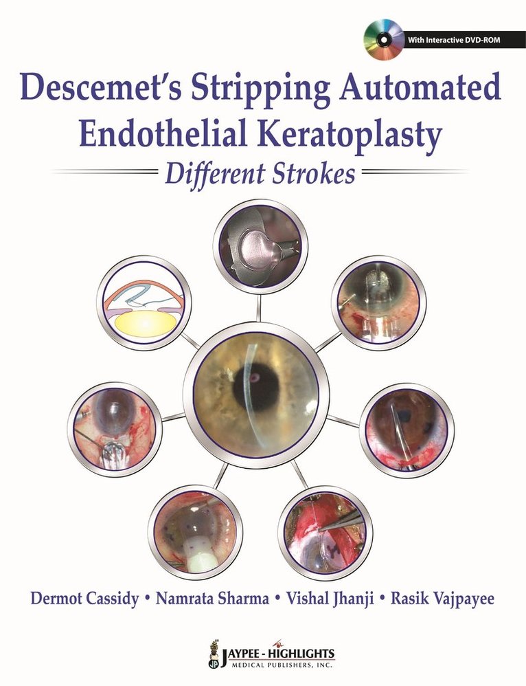 Descemet's Stripping Automated Endothelial Keratoplasty: Different Strokes 1