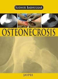 bokomslag Osteonecrosis