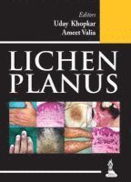 Uday Khopkar, Ameet Vaia, TBD - Lichen Planus, Häftad