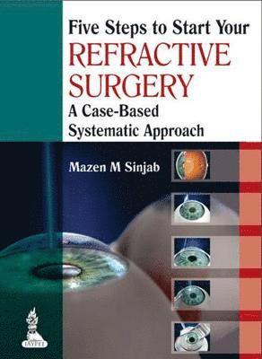 Five Steps to Start Your Refractive Surgery