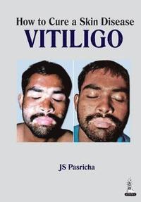 bokomslag How to Cure a Skin Disease: Vitiligo