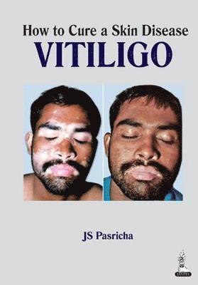 bokomslag How to Cure a Skin Disease: Vitiligo