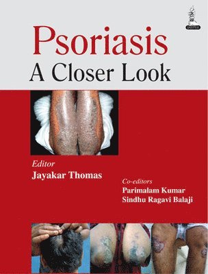 Jayakar Thomas - Psoriasis, Häftad