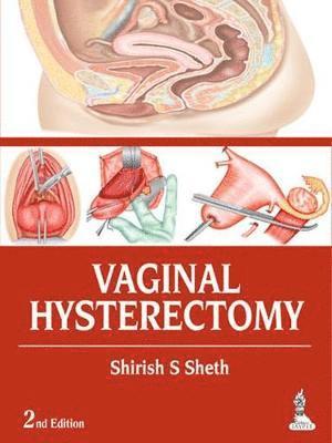 Vaginal Hysterectomy 1