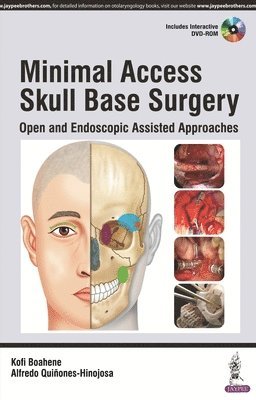 Minimal Access Skull Base Surgery 1
