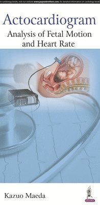 Actocardiogram 1