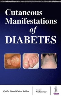 bokomslag Cutaneous Manifestations of Diabetes