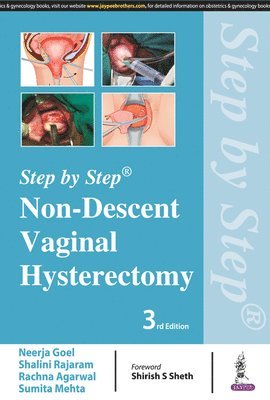 Step by Step: Non-Descent Vaginal Hysterectomy 1
