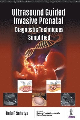 Ultrasound Guided Invasive Prenatal Diagnostic Techniques Simplified 1