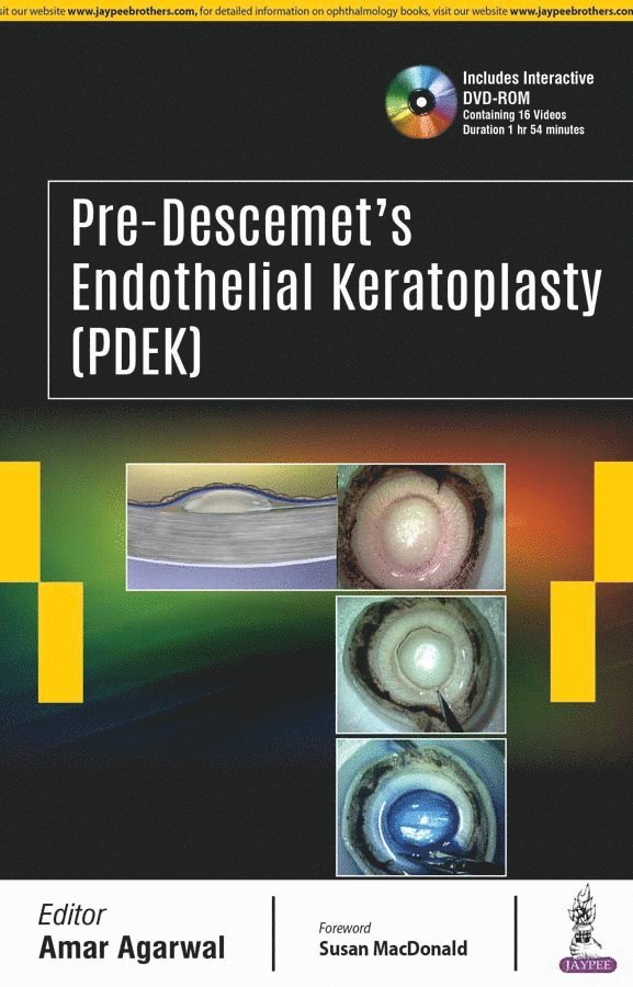 Amar Agarwal - Pre-Descemet’s Endothelial Keratoplasty (PDEK), Inbunden