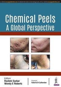 bokomslag Chemical Peels: A Global Perspective