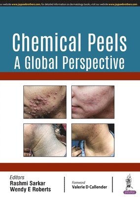 Chemical Peels: A Global Perspective 1