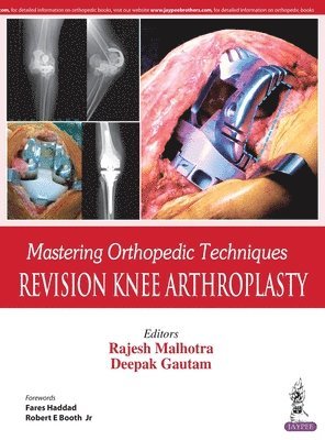 Mastering Orthopedic Techniques: Revision Knee Arthroplasty 1