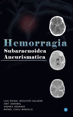 Hemorragia Subaracnoidea Aneurismatica 1