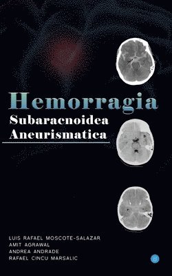 Amit Agrawal - Hemorragia Subaracnoidea Aneurismatica, Häftad