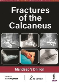 bokomslag Fractures of the Calcaneus