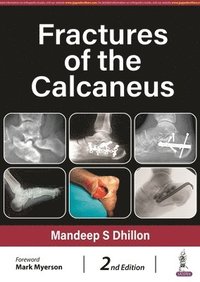 bokomslag Fractures of the Calcaneus