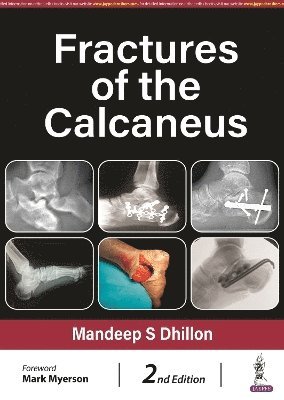 Fractures of the Calcaneus 1