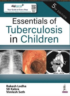 Essentials of Tuberculosis in Children 1