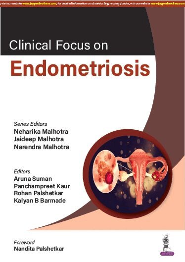 Neharika Malhotra, Jaideep Malhotra, Narendra Malhotra - Clinical Focus on Endometriosis, Häftad