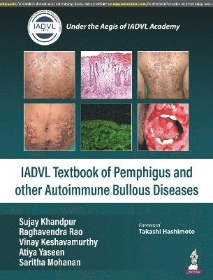 Textbook of Pemphigus and other Autoimmune Bullous Diseases 1