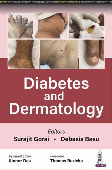 Surajit Gorai, Debasis Basu, Kinnor Das - Diabetes and Dermatology, Häftad