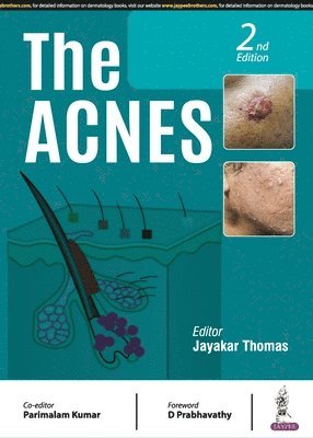 The Acnes 1