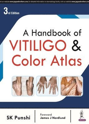 A Handbook of Vitiligo & Color Atlas 1