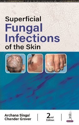 Superficial Fungal Infections of the Skin 1