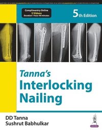 bokomslag Tanna's Interlocking Nailing