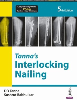 Tannas Interlocking Nailing 1