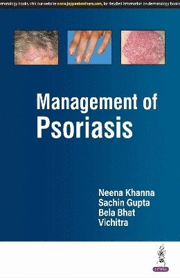 bokomslag Management Of Psoriasis