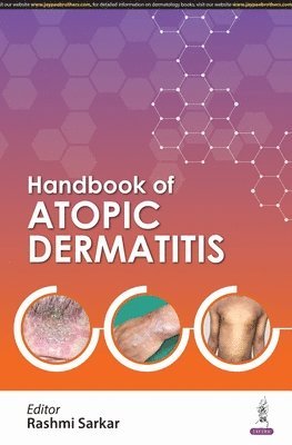 bokomslag Handbook of Atopic Dermatitis