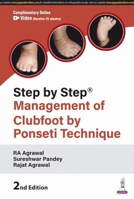 Step By Step: Management Of Clubfoot By Ponseti Technique 1