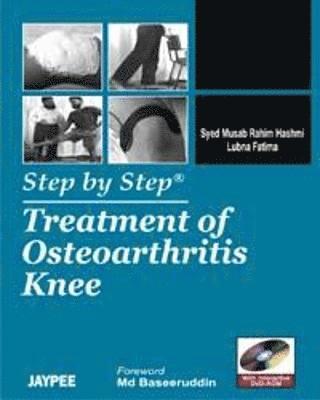 Step by Step: Treatment of Osteoarthritis Knee