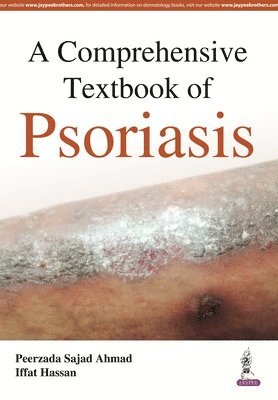 A Comprehensive Textbook of Psoriasis 1