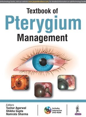 Textbook of Pterygium Management 1