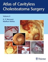 bokomslag Atlas of Cavityless Cholesteatoma Surgery, Vol 2