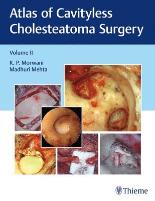 bokomslag Atlas of Cavityless Cholesteatoma Surgery, Vol 2