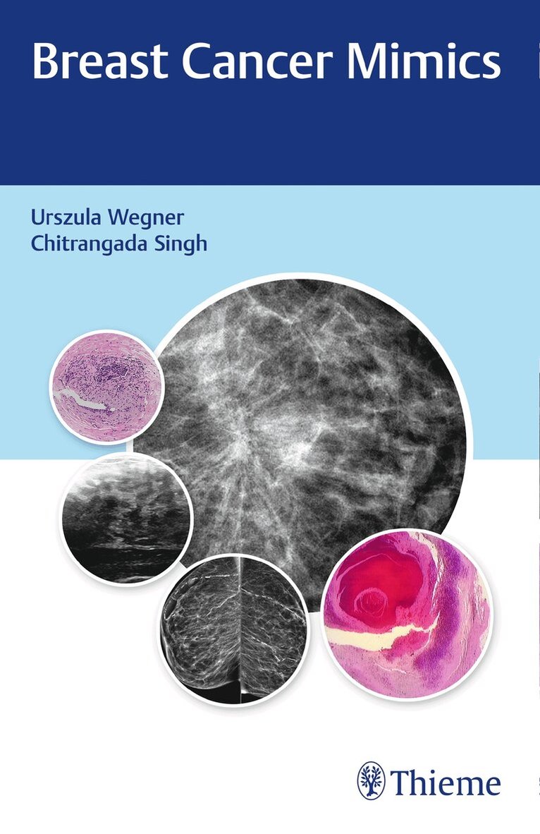 Urszula Wegner, Chitrangada Singh - Breast Cancer Mimics, Häftad