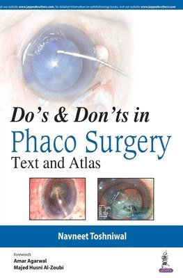 Do's & Dont's in Phaco Surgery 1
