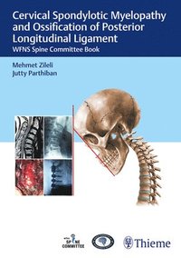 bokomslag Cervical Spondylotic Myelopathy and Ossification of Posterior Longitudinal Ligament