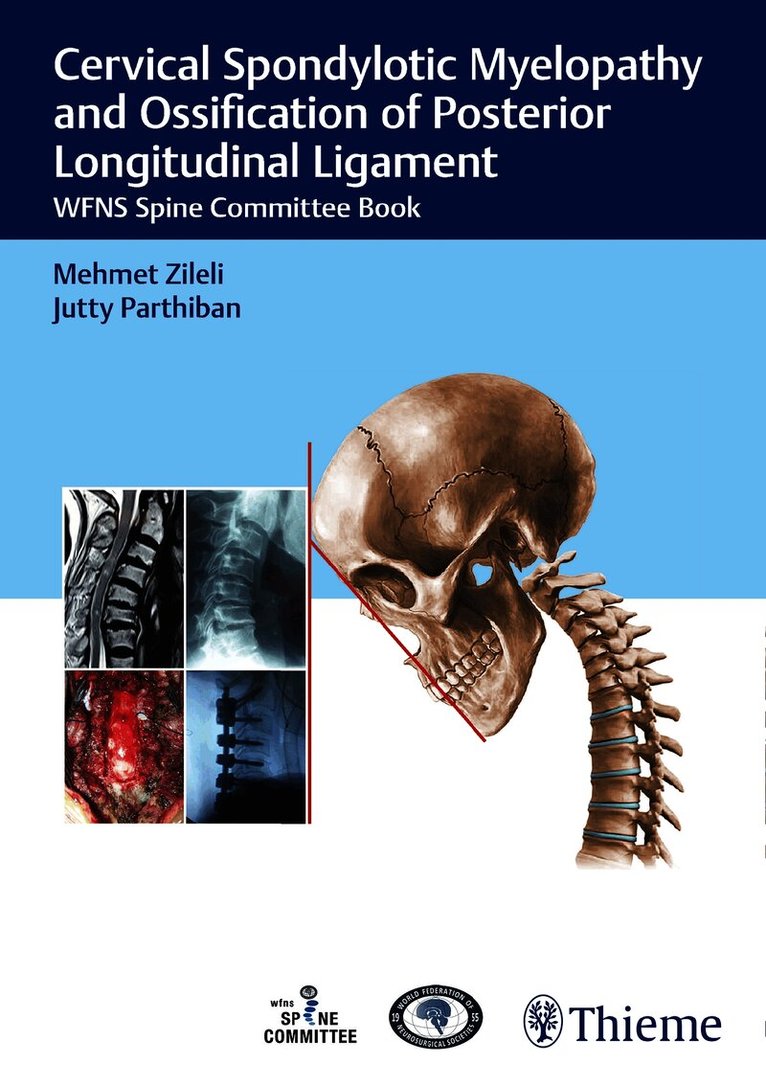 Cervical Spondylotic Myelopathy and Ossification of Posterior Longitudinal Ligament