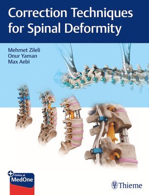 Correction Techniques for Spinal Deformity 1