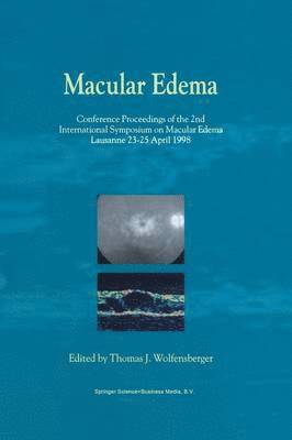 bokomslag Macular Edema