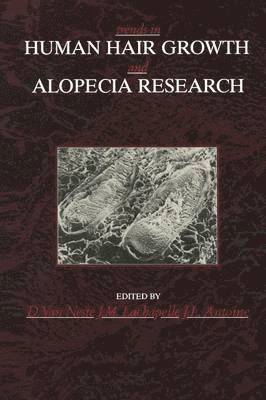 Trends in Human Hair Growth and Alopecia Research 1