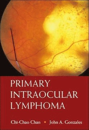 Chi-chao Chan, John A Gonzales, Usa) Chan, Chi-chao (Nat'l Eye Inst, Usa) Gonzales, John A (Univ Of Southern California, Los Angeles, Chi-Chao Chan, John A. Gonzales, CHAN CHI-CHAO - Primary Intraocular Lymphoma, Inbunden